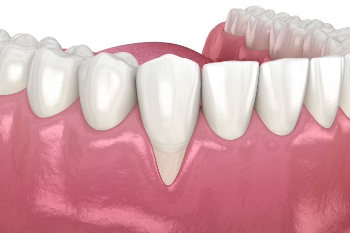 歯周形成・歯周再生療法